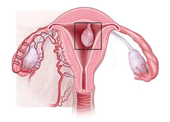 полипоз эндометрия матки