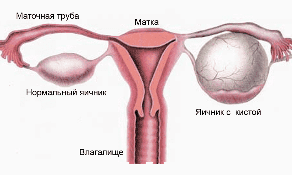 Яичник без кисты и яичник с кистой (сравнение)