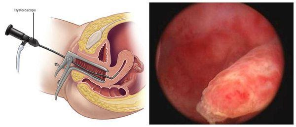 Как диагностируются полипы эндометрия