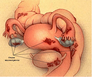Эндометриоз органов малого таза