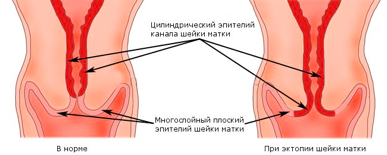 При эктопии шейки матки